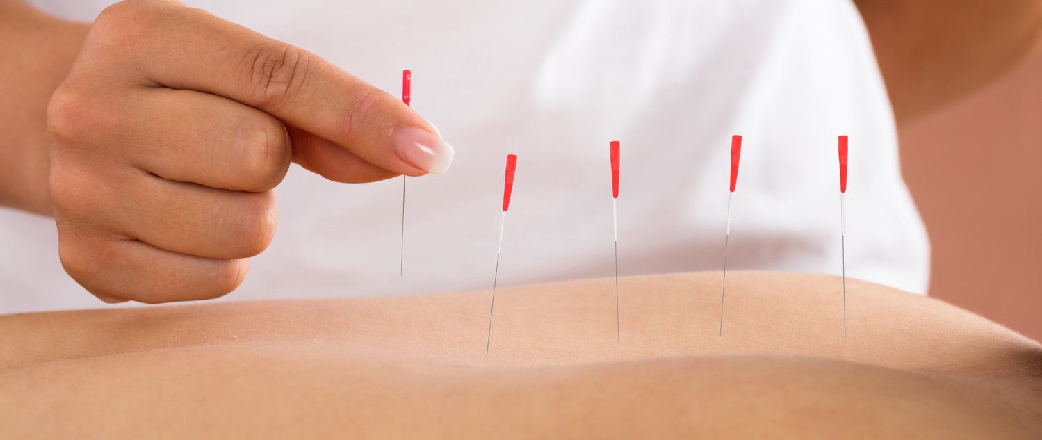 Imagem do serviço: Dry Needling (agulhamento seco)
